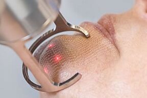 fractional laser rejuvenation technology
