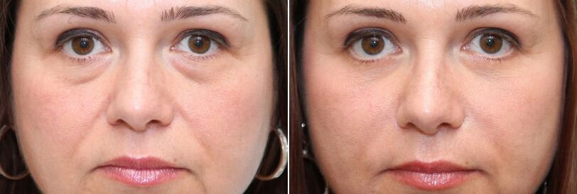 Before and after blepharoplasty - removal of the fat body under the eyes and skin tightening
