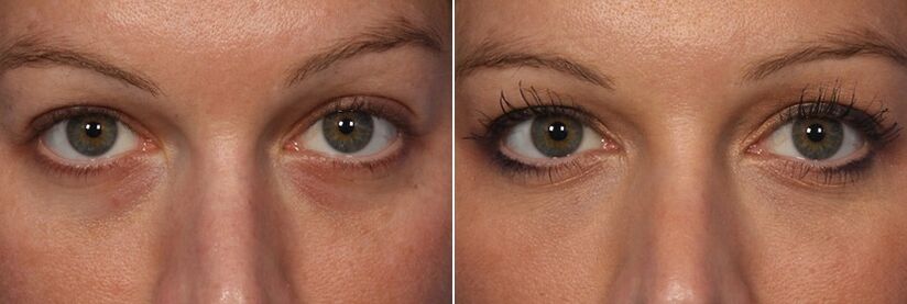 Before and after using injectable fillers - reducing dark circles
